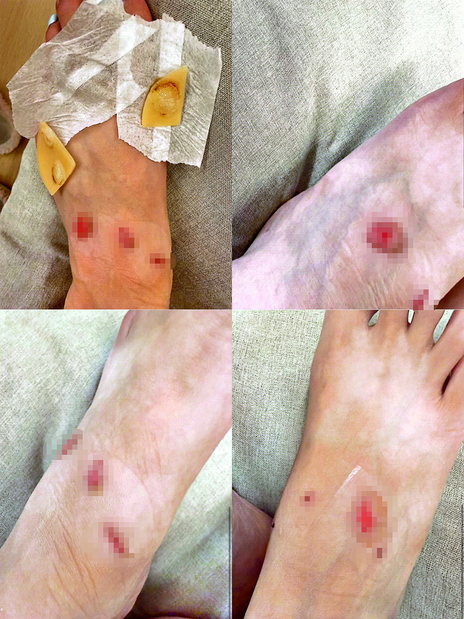 女子购近万元LV运动鞋穿后双脚多处破皮要求退款被拒，客服：不退，只能换(图4)