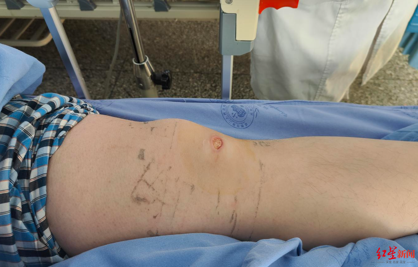 女子睡觉用暖宝宝暖脚被烫伤，创口感染现“