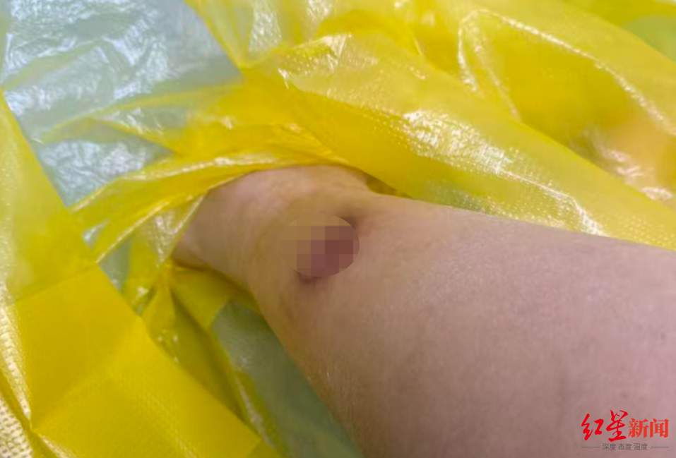 女子睡觉用暖宝宝暖脚被烫伤，创口感染现“深坑”！医生：冬季低温烫伤高发，取暖莫大意(图2)