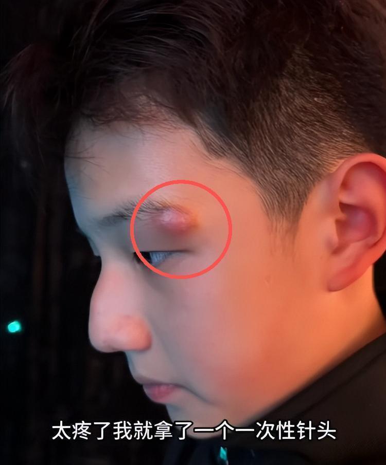 太无知！关凌硬挤儿子脸上痘，导致严重感染，做手术缝4针恐留疤(图26)