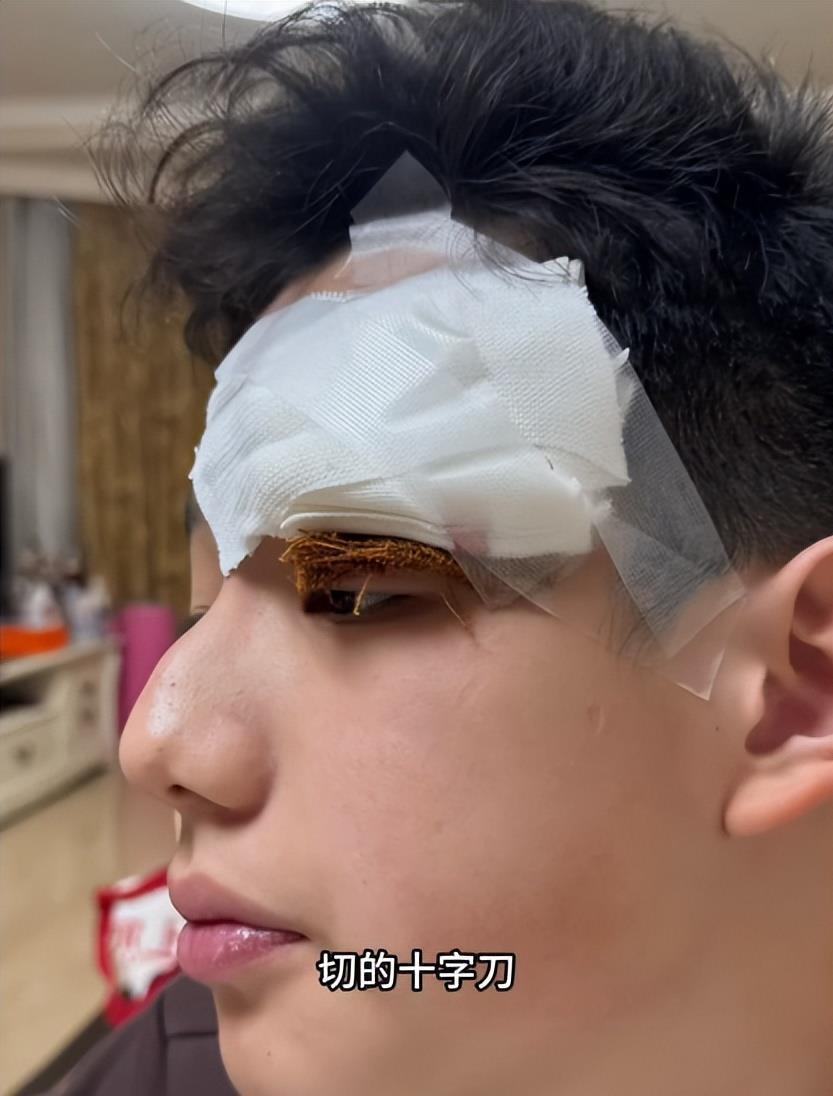 太无知！关凌硬挤儿子脸上痘，导致严重感染，做手术缝4针恐留疤(图29)