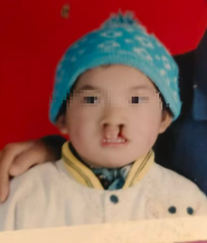 唇腭裂患者漫长的人生“修复”