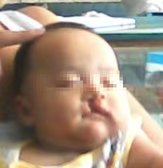 唇腭裂患者漫长的人生“修复”(图3)