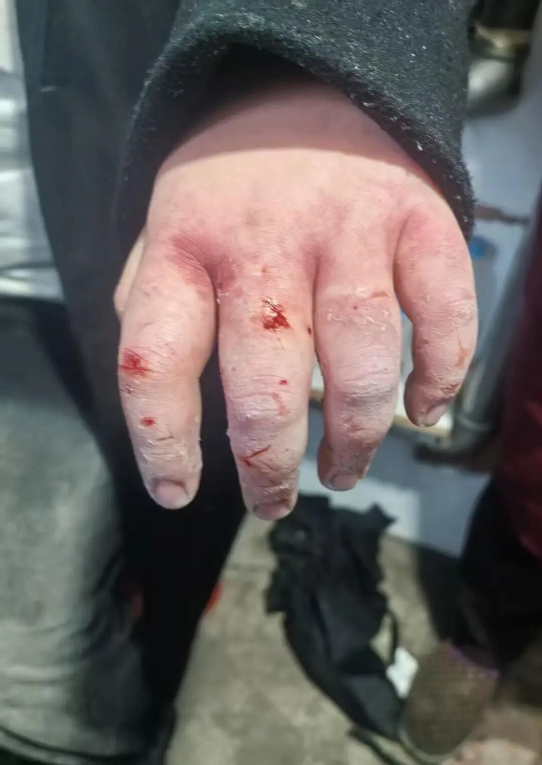 女大学生到东北游玩意外晕倒，在雪地冻伤，3根手指或面临截肢(图3)