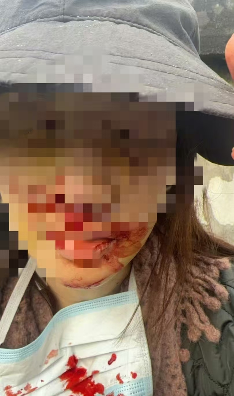 警方通报金晨被曝肇事逃逸，金晨发文致歉：为躲避蹿出小狗撞墙，伤势较重先行就医手术(图3)