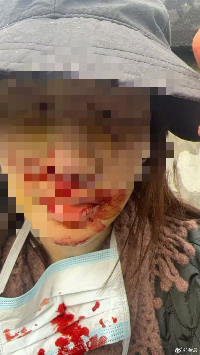 金晨就交通事故致歉，晒出受伤照片(图1)
